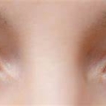 Bệnh đau mắt đỏ (conjunctivitis)