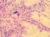 Gút cột sống - spinal gout