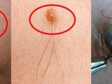 NỐT RUỒI Ở VỊ TRÍ NÀO CẢNH BÁO UNG THƯ ?