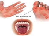 Khuyến cáo phòng bệnh tay chân miệng ở trẻ em