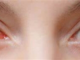 Bệnh đau mắt đỏ (conjunctivitis)