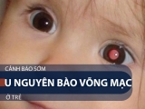 HÃY CỨU LẤY ĐÔI MẮT CỦA TRẺ KHI CÓ THỂ-UNG THƯ VÕNG MẠC
